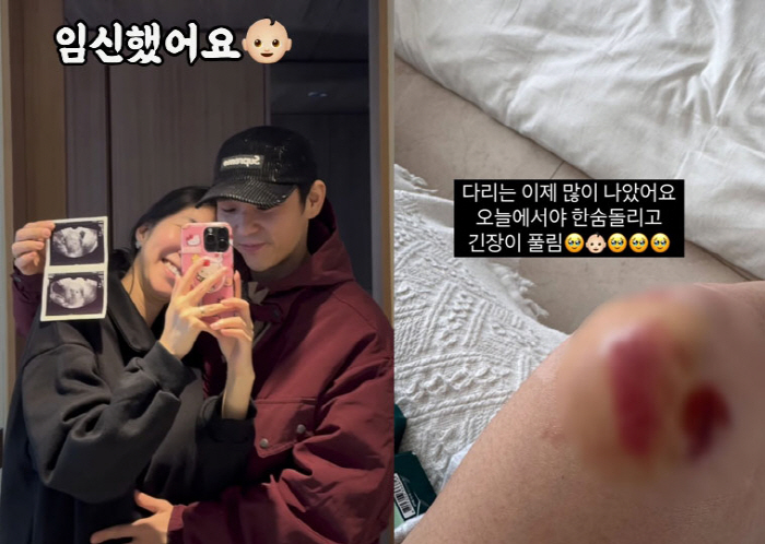 Twin Pregnant Kim Ji-hye, Serious Fall Accident...a crack in one's fingers