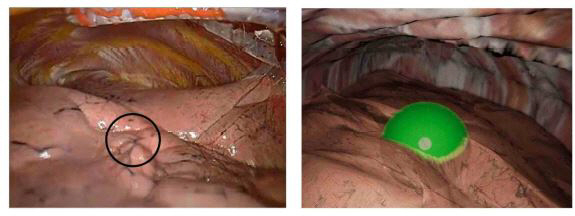 3D patent technology enables actual closed state...Development of Lung Nodulation Position Visualization Thoracic Simulation