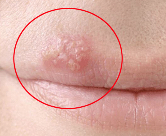 Herpes Virus Infection Approximately Doubles Risk of Alzheimer's Disease