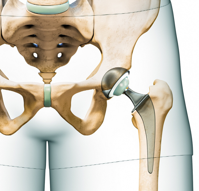 The main cause of the artificial hip reoperation, it turns out...