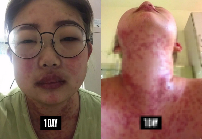 Choi Jun-hee, who lost 55kg, binge-watched like a YouTuber with serious lupus drug side effects, and her face crumbles
