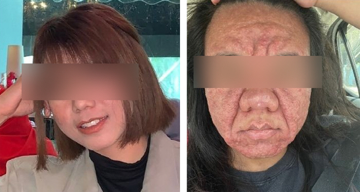20's Woman Explodes With Acne After Being Pregnant...He's got a bumpy face. He's in his 60s