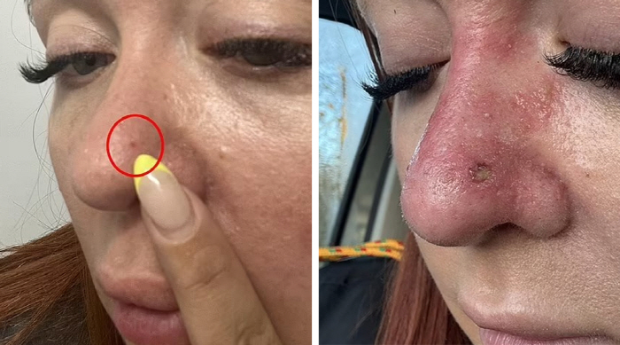 A pimple on my nose. I thought it was a pimple…Skin cancer diagnosis twice in 3 years