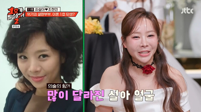 Seola Choi's eye and nose plastic surgery, side effects of liposuction in thighs and lower abdomen (No. 1)