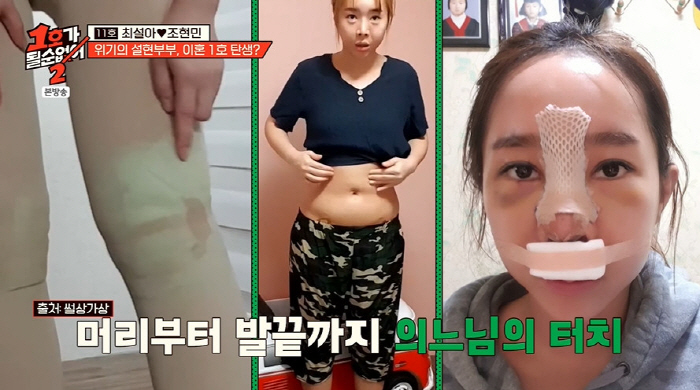 Seola Choi's eye and nose plastic surgery, side effects of liposuction in thighs and lower abdomen (No. 1)