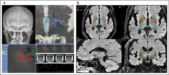 World's First Success in Intensive Ultrasound Surgery on Deep Brain Stimulator Transplantation Patients