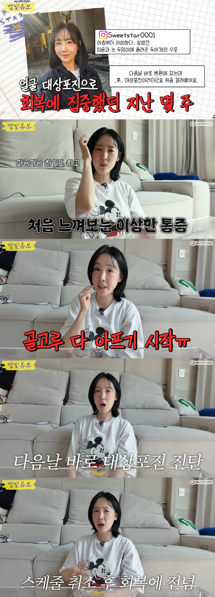 Haha ♥ Byul, even with facial shingles, her schedule is forced to cover her right face with blisters