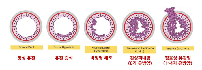  Self-examination every month over the age of 30...3 causes of increase in incidence