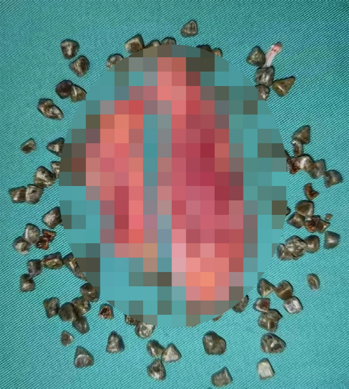 Woman who enjoyed late-night snacks for 10 years shocked to discover nearly 100 stones in her body