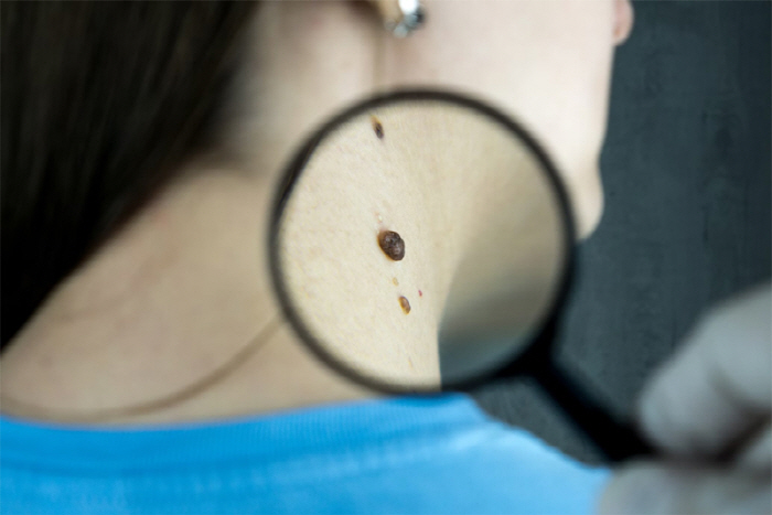 I thought it was a freckle spot, but skin cancer...melanoma spread all over the body