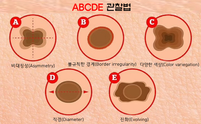 I thought it was a freckle spot, but skin cancer...melanoma spread all over the body