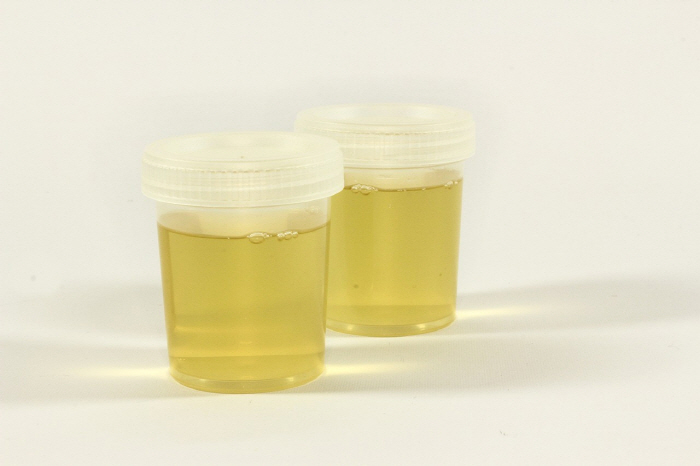 Once broken, check the kidney that is difficult to recover from, the color and smell of urine at Himchan Hospital