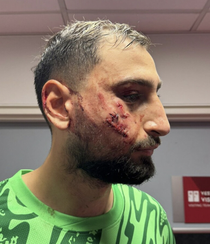 I even cut my face and blocked it! Wall GK's decision to break up with the main player in UCL's victory, demanding a salary cut