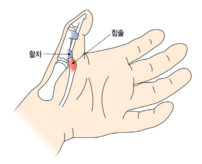 Trigger Fingers Click From Fingers, Attention Women in Their 50s...What about prevention and treatment?