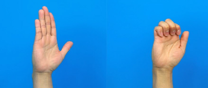 Trigger Fingers Click From Fingers, Attention Women in Their 50s...What about prevention and treatment?