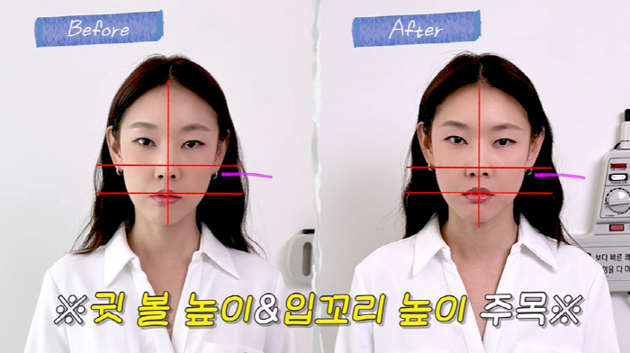 Han Hye-jin's face was twice as thick as both cheeks that changed significantly after acupuncture surgery (Han Hye-jin)