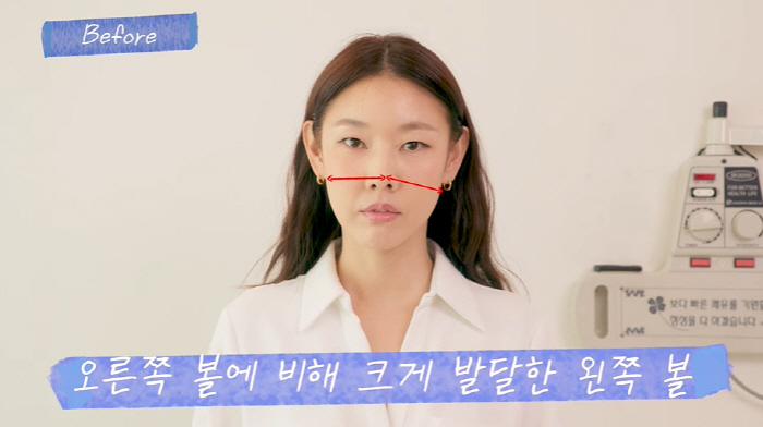 Han Hye-jin's face was twice as thick as both cheeks that changed significantly after acupuncture surgery (Han Hye-jin)