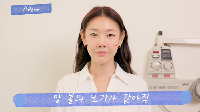 Han Hye-jin's face was twice as thick as both cheeks that changed significantly after acupuncture surgery (Han Hye-jin)