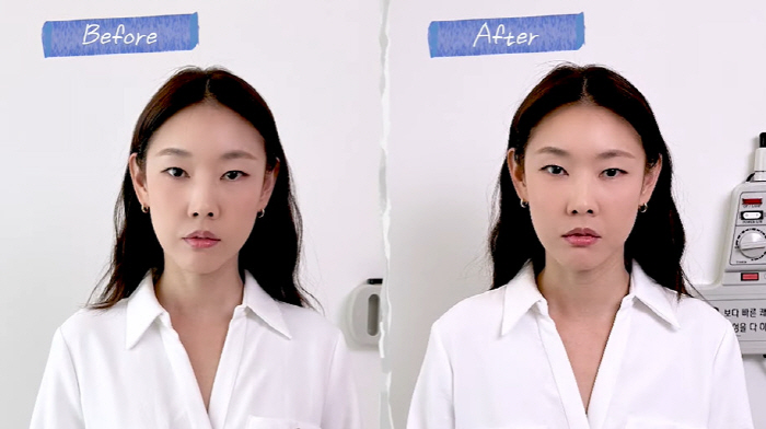 Han Hye-jin's face was twice as thick as both cheeks that changed significantly after acupuncture surgery (Han Hye-jin)