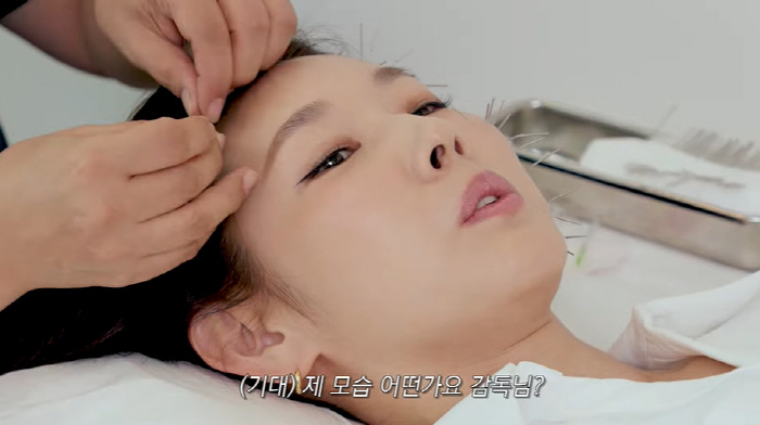 Han Hye-jin's face was twice as thick as both cheeks that changed significantly after acupuncture surgery (Han Hye-jin)