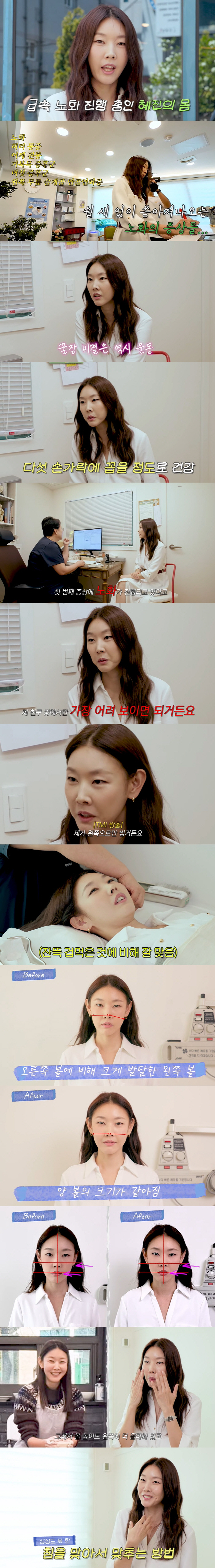 Han Hye-jin's face was twice as thick as both cheeks that changed significantly after acupuncture surgery (Han Hye-jin)