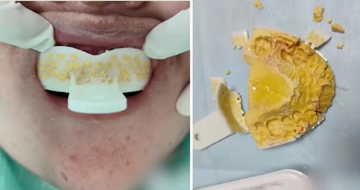 I almost lost my life trying to get my own braces...There's a reason why dentistry is expensive