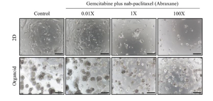 Prediction of Pancreatic Cancer New Drug Effect with Mini Organoid Organoids...Accelerate the development of customized treatments and new drugs
