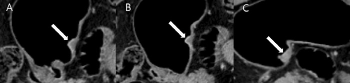 Determining gastric cancer stage, developing a new CT diagnostic method...Increase accuracy to maximize treatment effectiveness