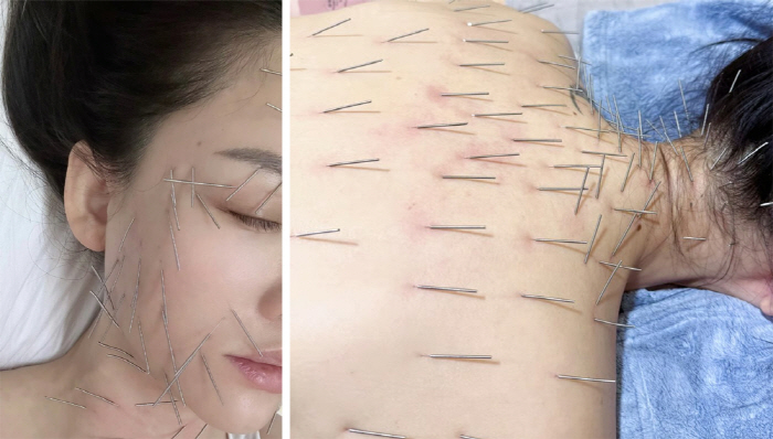 The secret to skin and body while a famous actor is acupuncture...Put more than 100 spits from your face to your hips