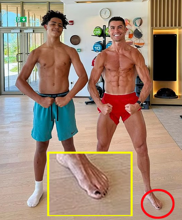 Ronaldo Thumb Toenail Black? Thought it was Fashion...