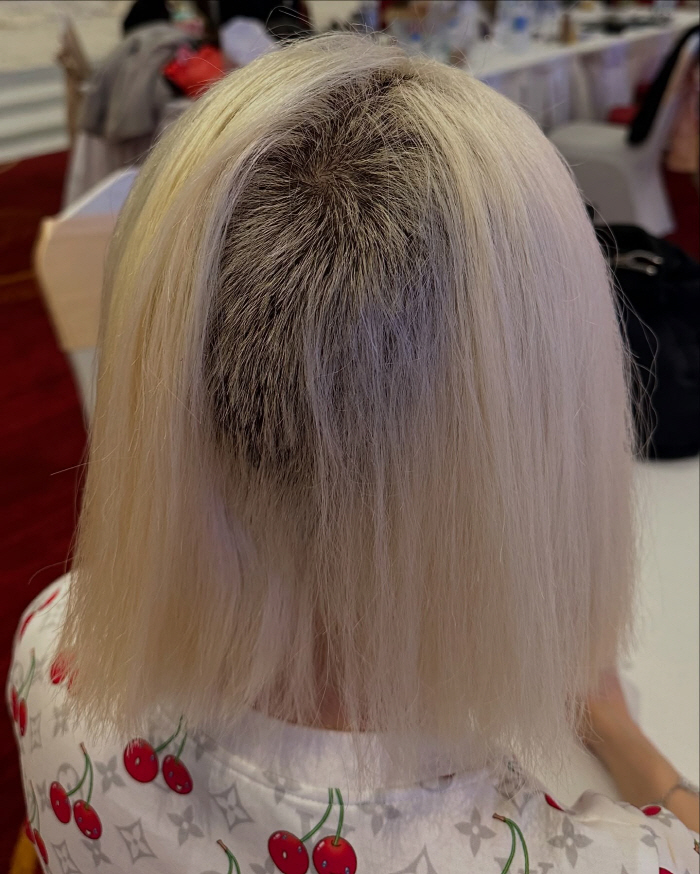 DJ Soda Shocked Hair Loss...I bleached my hair and left it for a long time, and it melted from the roots