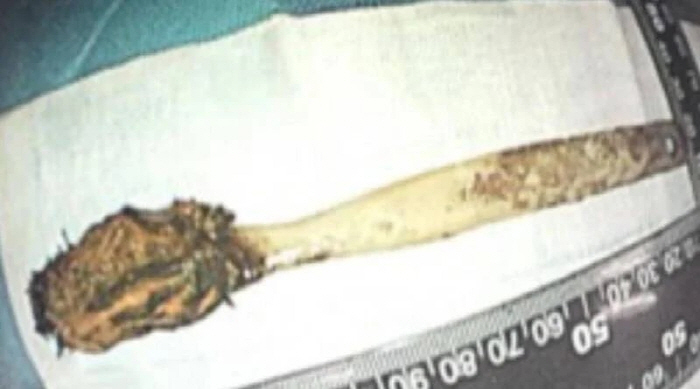 I found a toothbrush I swallowed 52 years ago in my body...I knew it would break down