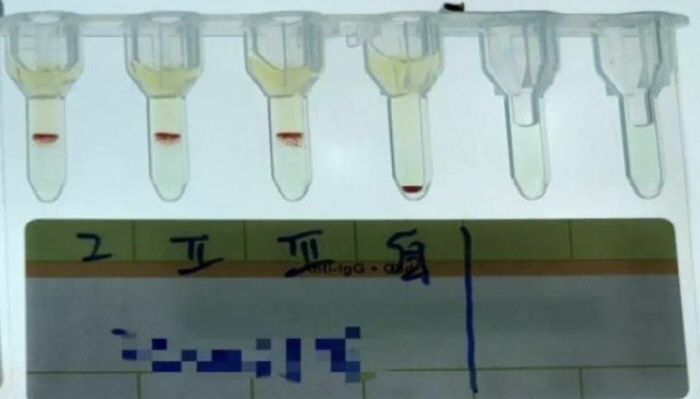 Small P type blood type found rarer than dinosaur blood...less than one in a million people