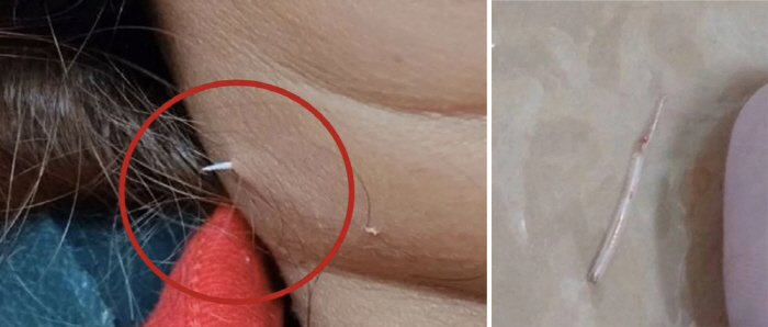 Thorns of swallowed fish come through the skin of the neck...It's like a 2cm long needle