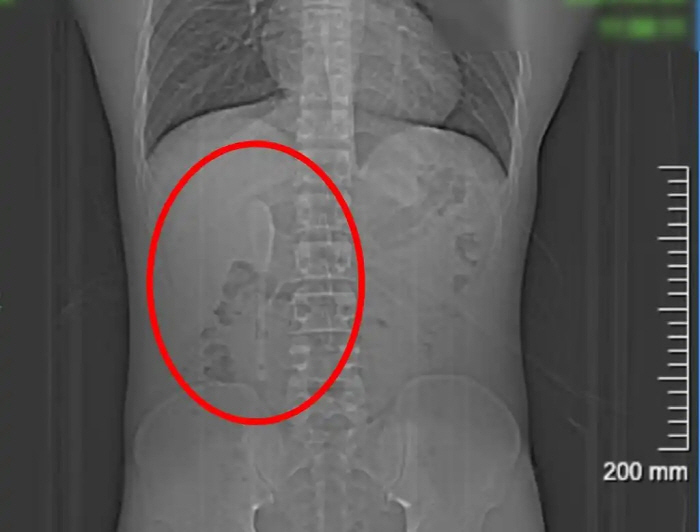 I thought it was a dream...A spoon in my body for five months