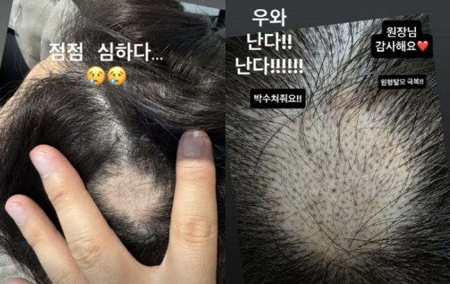Lee Sol ♥ Park Sung-kwang overcame severe circular hair loss