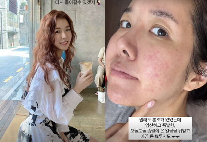Twin Pregnant Kim Ji-hye Explodes Redness, Cholipid, and Puff after Falling Accident