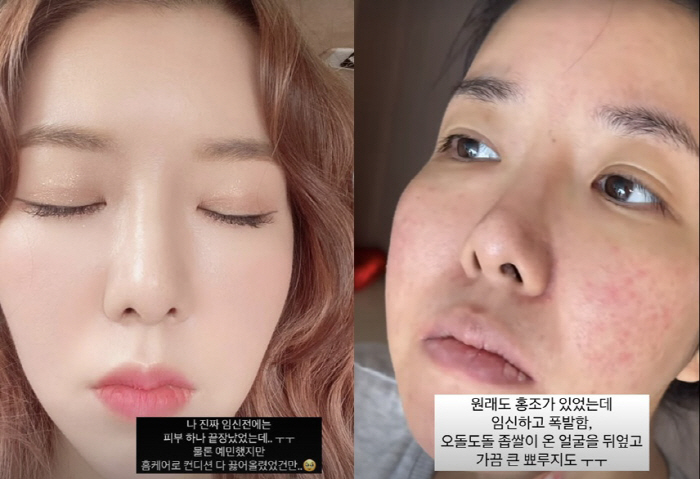 Twin Pregnant Kim Ji-hye Explodes Redness, Cholipid, and Puff after Falling Accident