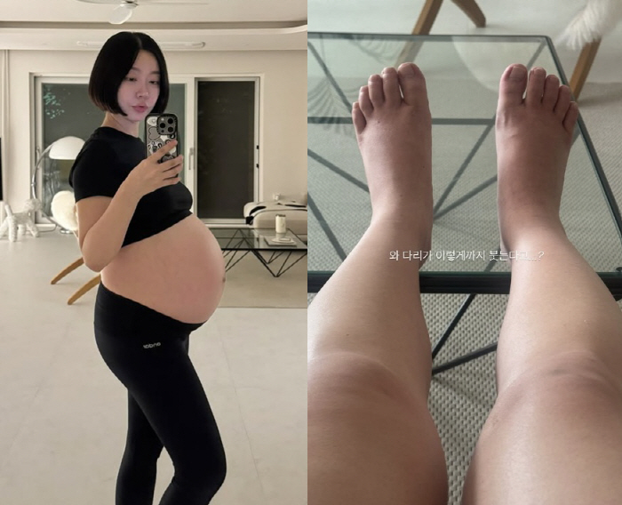 Twin Pregnant Lady Jane, I can't believe she's having a serious leg swelling before giving birth