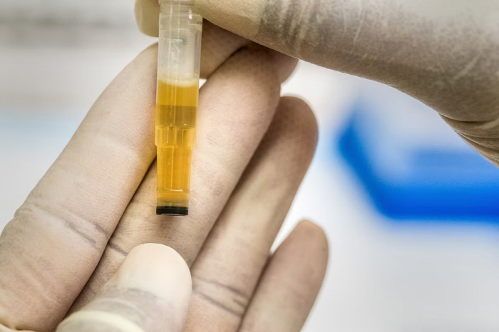 Bladder cancer recurrence, urine acidity predictable...Expectation of Customized Treatment