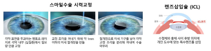 I compared the effects of vision correction during the vacation season, smile LASIK, and lens insertion...