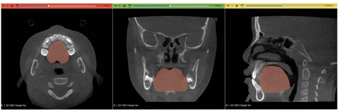 a spatula-jawed man with a big tongue...Find out the correlation between facial growth and tongue