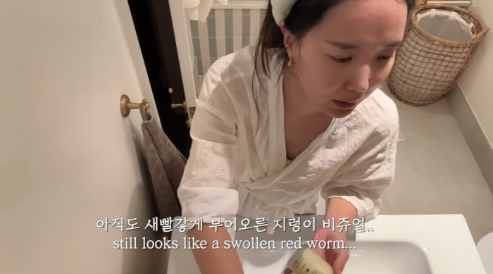 British man ♥ National expense, C-section scar serious 1 year after giving birth, he looks like a red earthworm