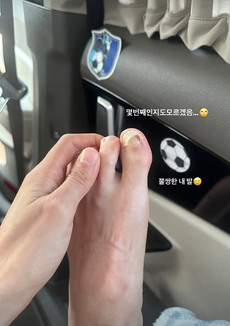 Lee Hyun-yi is in a shocking state just before she falls off her toenail...My poor feet