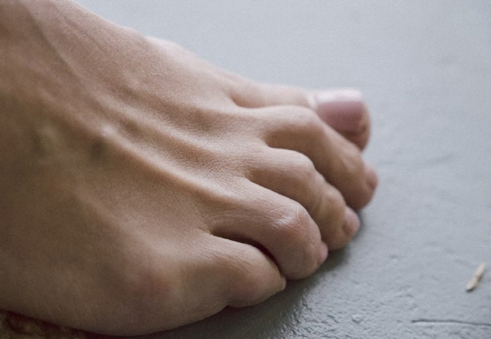 Hot and humid summer season, athlete's foot watch...No use of vinegar and garlic!