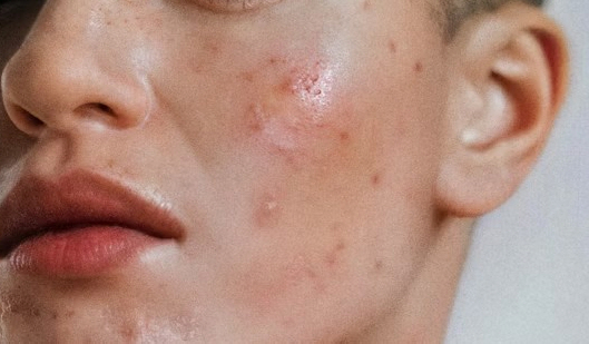 Acne that doesn't heal, non-drug treatment, summary...When you compare the effects