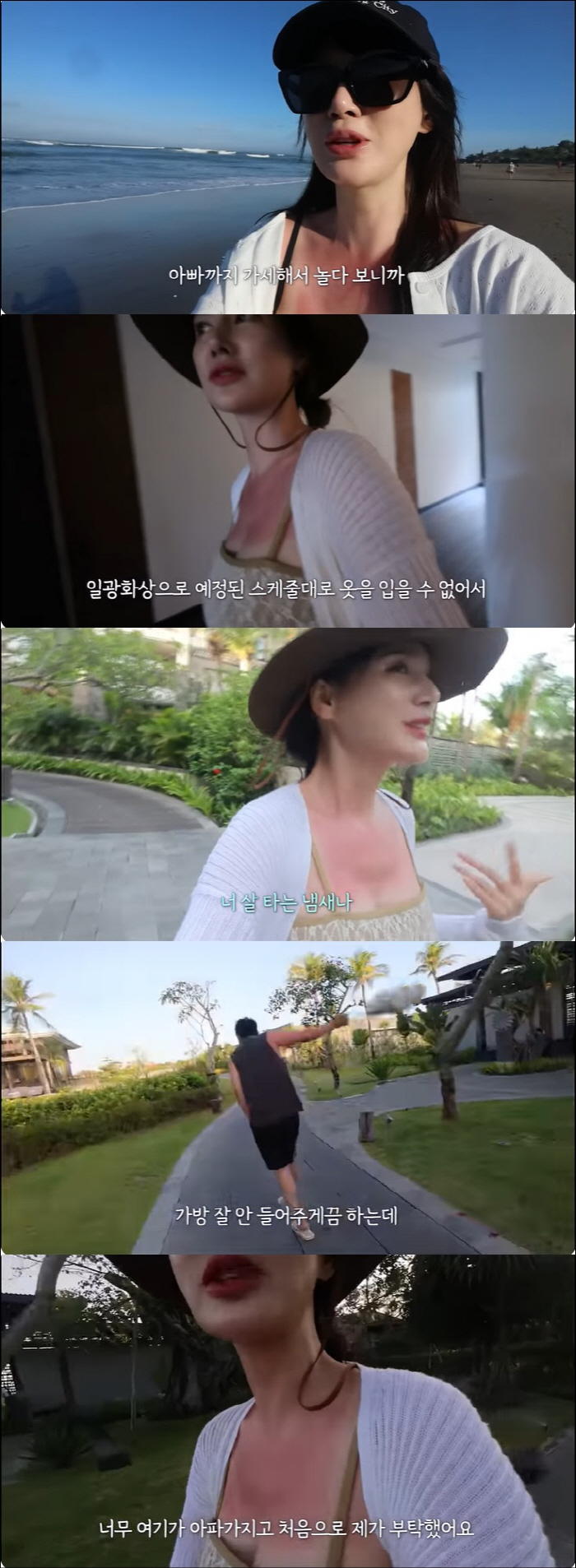 Ahn Jung-hwan ♥ Lee Hye-won got burned during a trip to Bali It hurts so much that I can't even wear clothes