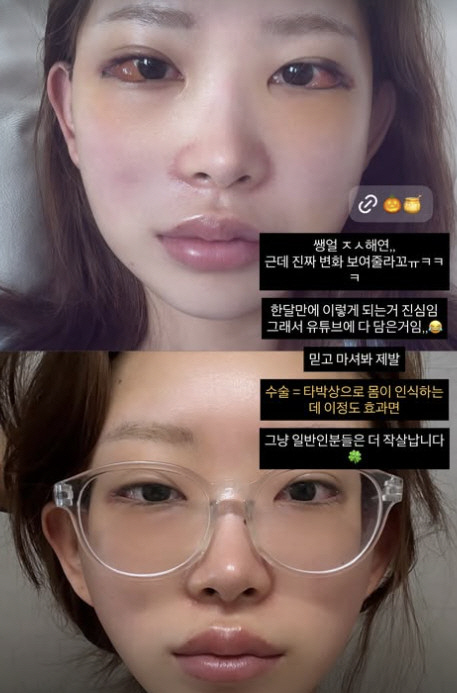 Choi Jin-sil's daughter Choi Jun-hee poured white into cheekbones and eye plastic surgery...A surprising change in a month
