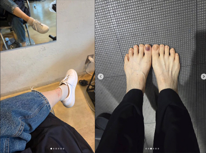 Kim Tae-wook ♥ Cha Si-ra reveals her blackened toenails... Please don't fall out