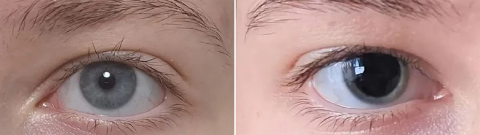 I posted a picture of my eyes online, so go to the hospital quickly...I saved my life